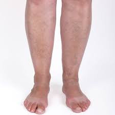 Varicose veins