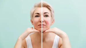 Rosacea treatment